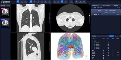 A new method for evaluating lung volume: AI-3D reconstruction